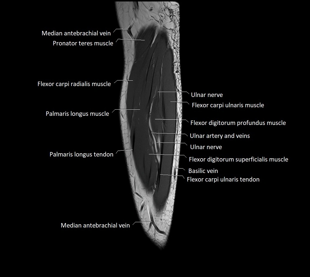 MRI 3T forearm sagittal labelled cross sectional anatomy image 34.webp